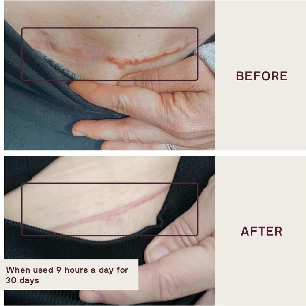 Dermaclara C-Section Patch - Picture 2 of 6